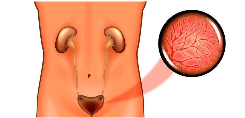 Cystite chez les symptômes et traitement des hommes