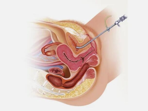 Diagnostic de cystite